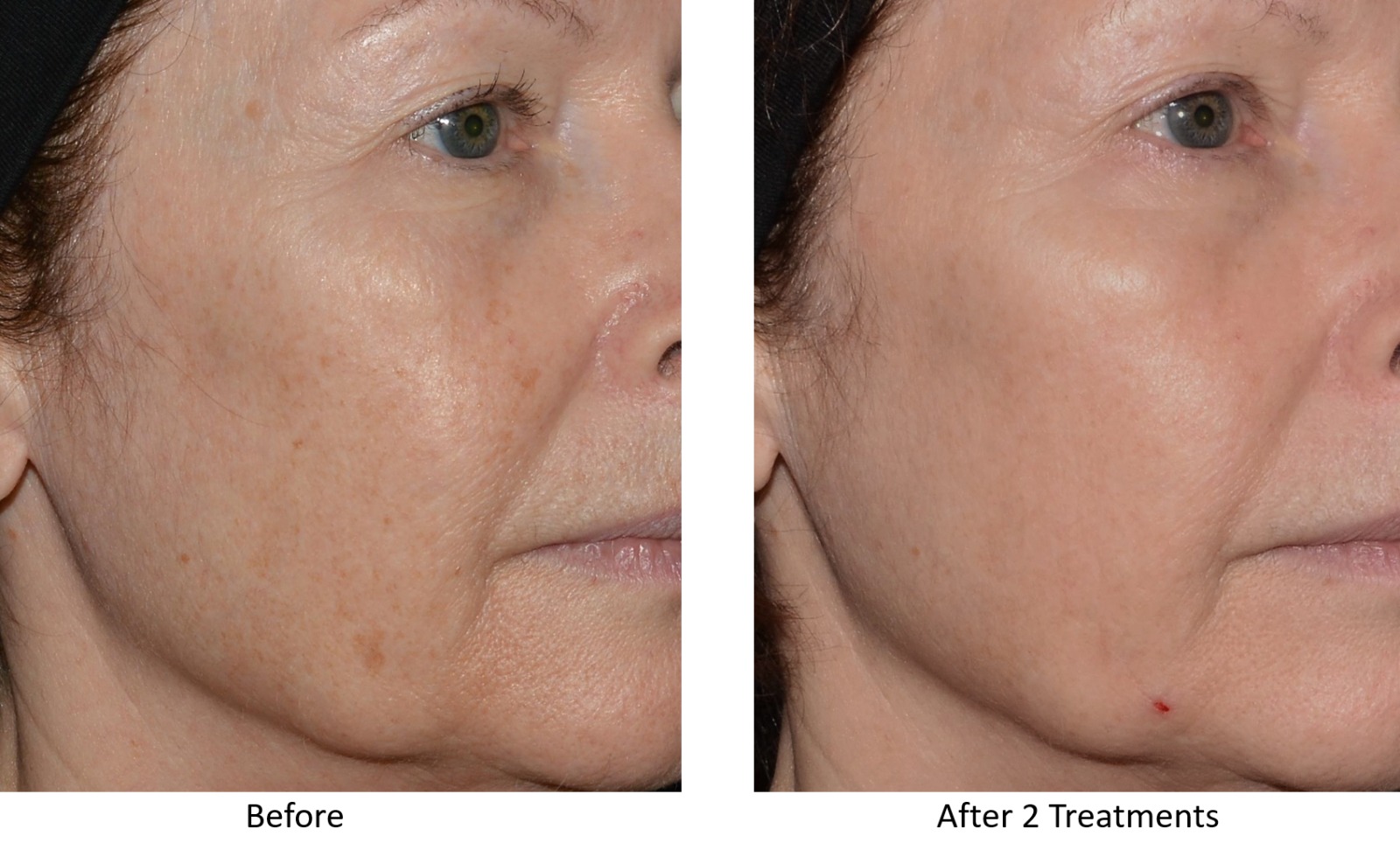 LaseMD Ultra Before and After - Hyperpigmentation